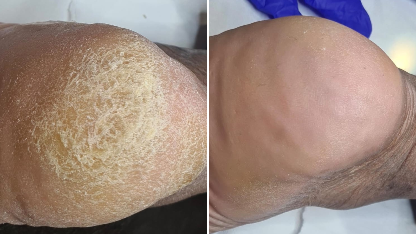 Before and after cracked heels