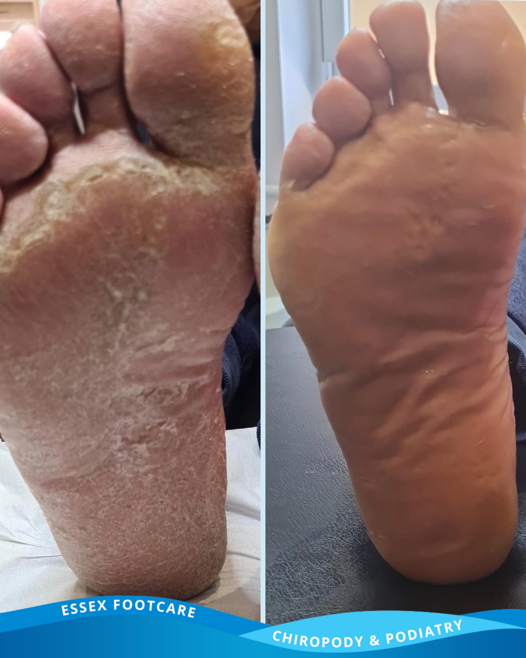 Cracked heels before and after