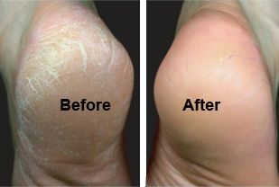 cracked heels 2