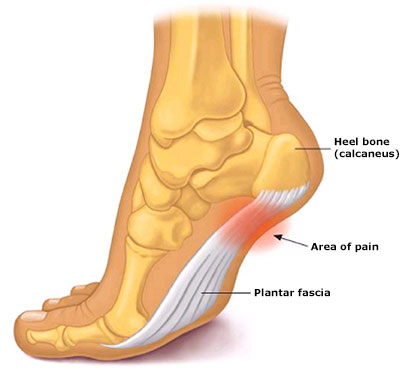 heelpain plantar