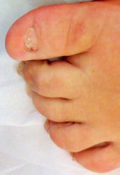 Unsightly Toe nails before treatment Unsightly Toe nails before treatment